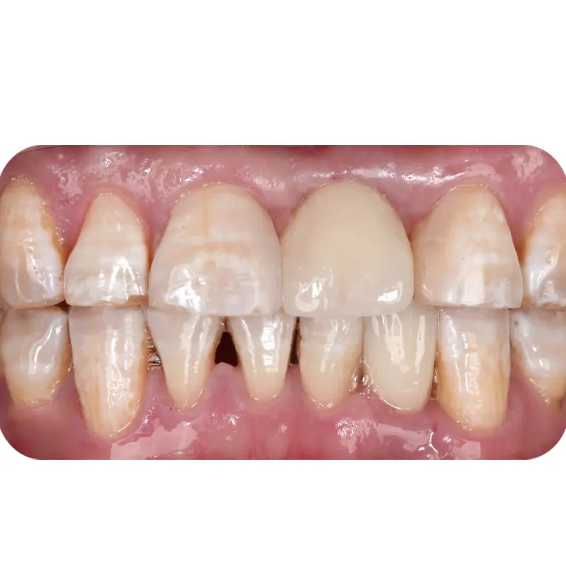 Sau khi điều trị